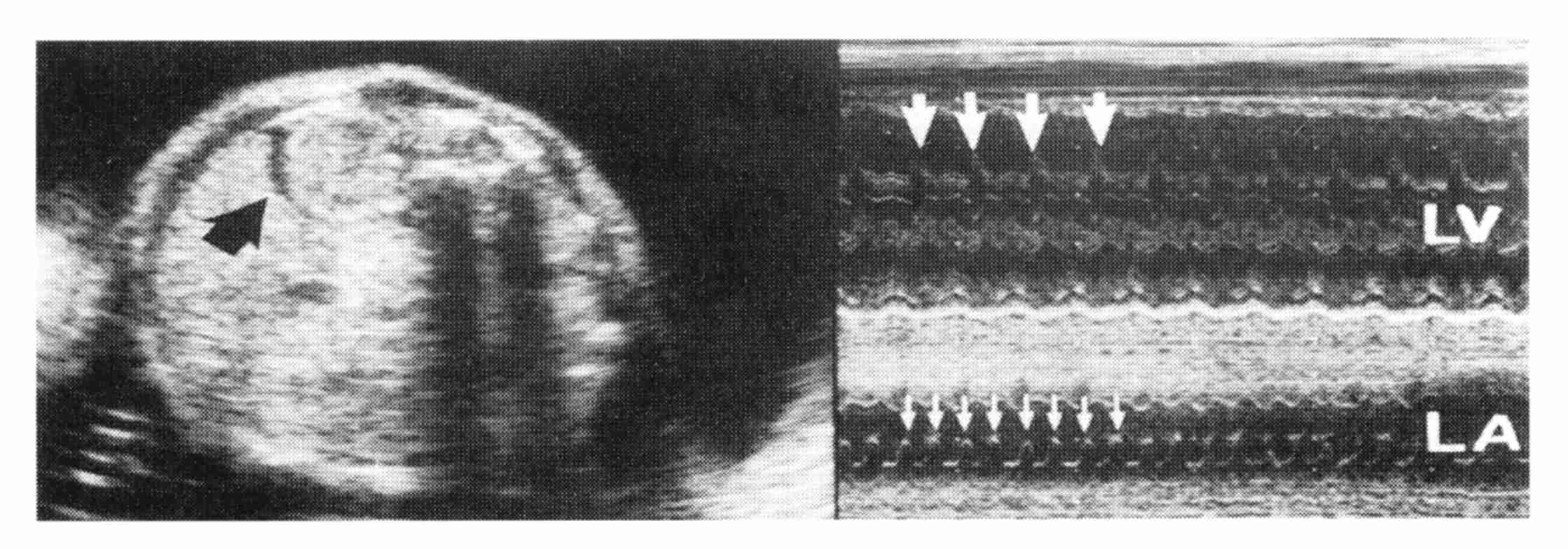  Ryc. 2. A) Ultrasonogram jamy brzusznej płodu w 29. tygodniu, z widoczną tachyarytmią i wczesnym wodobrzuszem (strzałka
