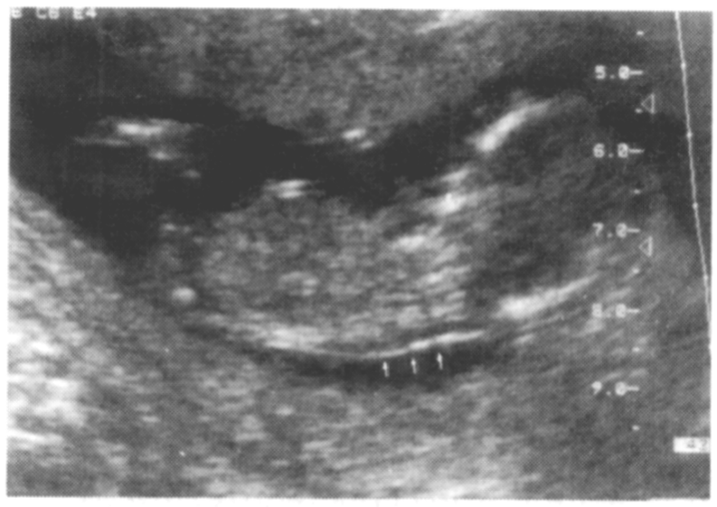  Ryc.1. NT (nuchal translucency) karkowa przejrzystość u 10-o tyg. płodu wielkości 1, 8 mm. w tym stadium sięgająca częs