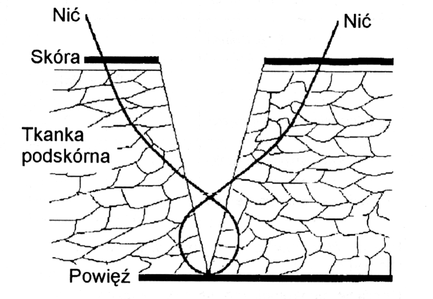 Ryc. 1. Pionowy ósemkowy szew materacowy