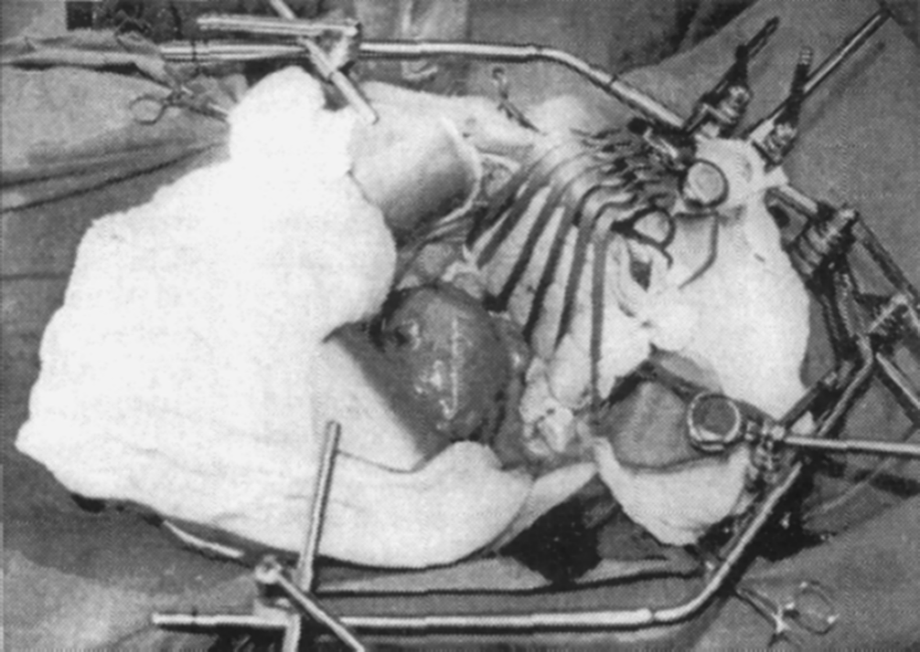  Ryc. 5. U tej patologicznie otyłej pacjentki cierpiącej na nieregularne krwawienia spowodowane obecnocią dużych mięśnia