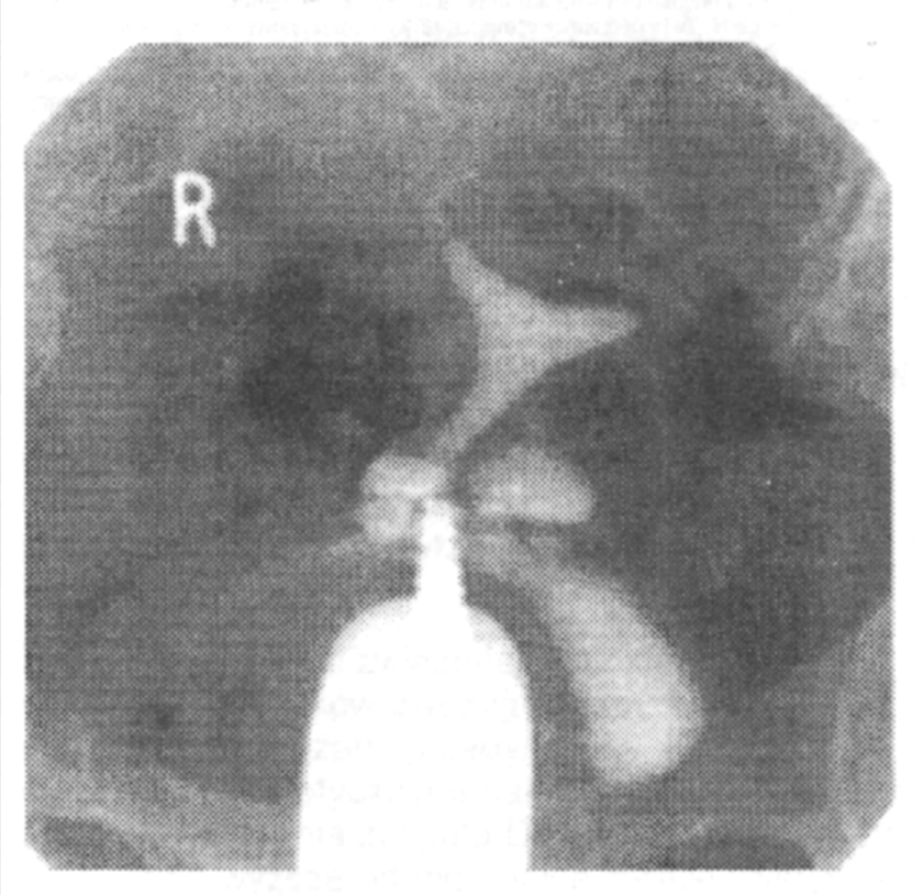  Ryc. 1. Histerosalpingogram w projekcji AP wykazuje przechodzenie kontrastu do pęcherza (w szyjce widoczny cewnik Leech