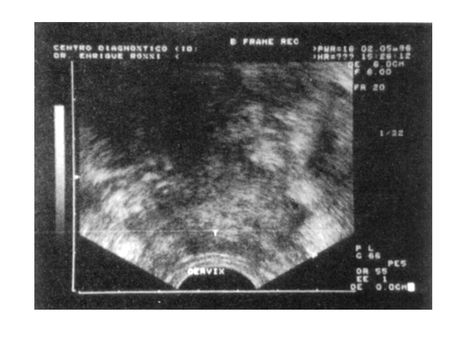  Ryc. 4. Stopień II b raka szyjki macicy. Ultrasonografia przezodbytnicza. Wciągnięcie przymacicz w proces chorobowy, ch