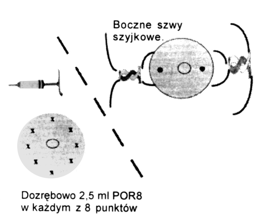 Ryc. 1. Metody hemostatyczne. Na lewo: ostrzyknięcie środkiem zwężającym naczynia z ośmiu stron szyjki. Na prawo: boczn