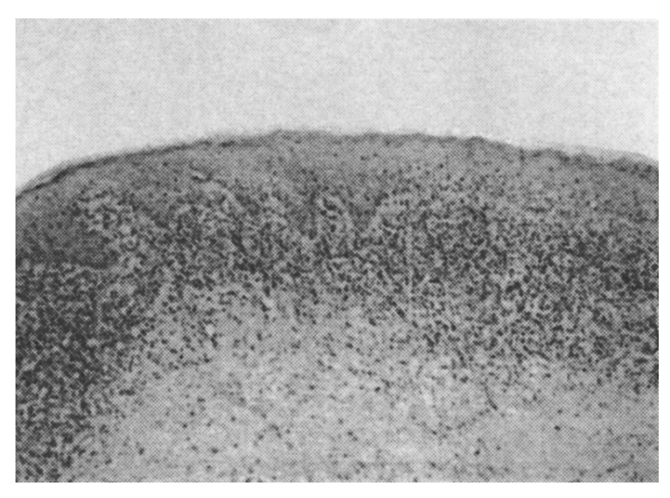  Ryc. 2. Preparat histologiczny skóry sromu w typowym liszaju płaskim 