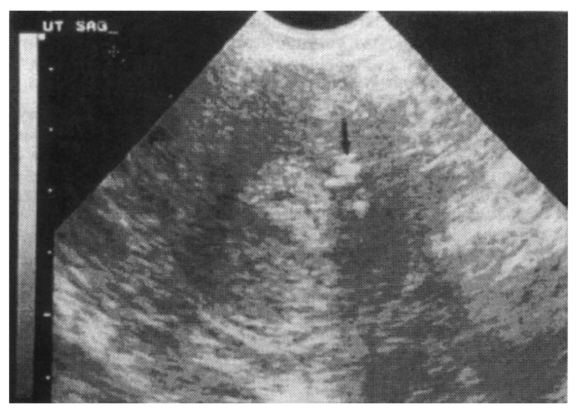  Ryc. 3. Hiperechogeniczny obszar tuż obok jamy macicy (strzałka). Ten obszar małych gruczołów endometrialnych penetrują
