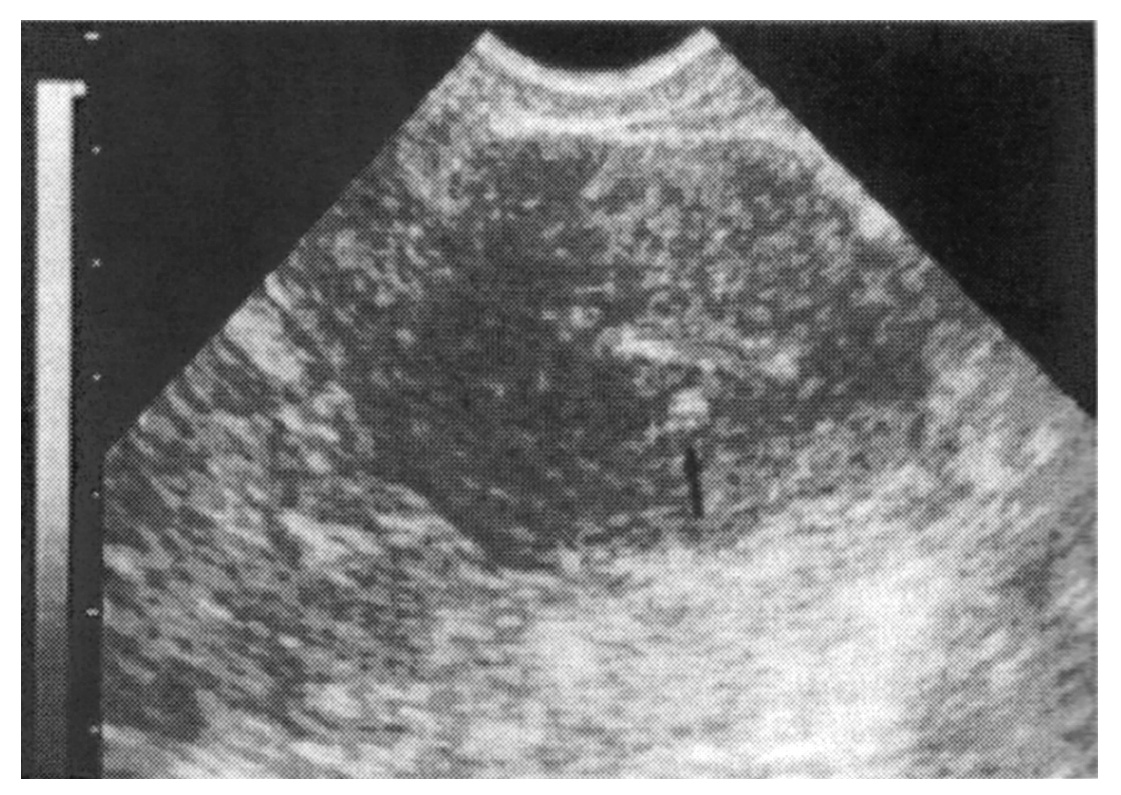 Ryc. 5. Hiperechogenne obszary (strzałka) przedstawiają małe gruczoły endometrialne. Hiperechogenne ogniska na przeciwl