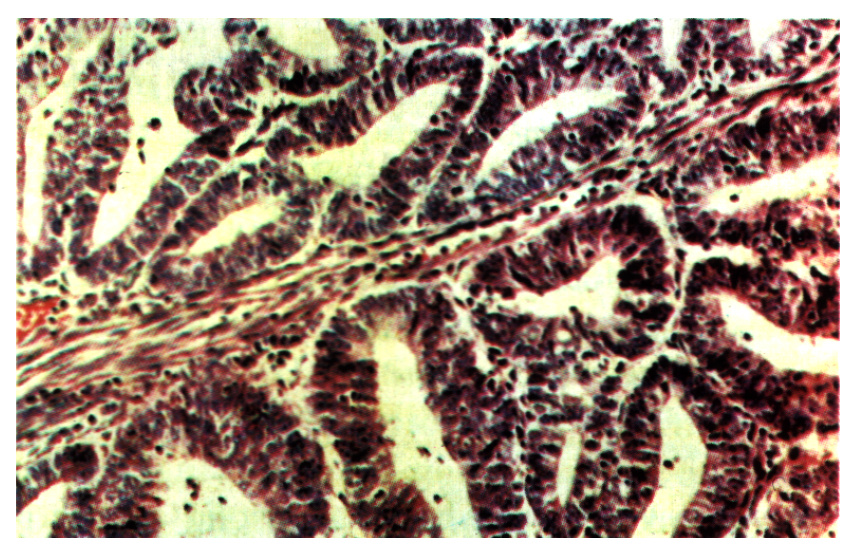 Ryc. 4. Gruczolakorak endometrium -postać atypowa. Jest to typ wysoko zróżnicowany (stopień I), bez wzrostu litego. Kom