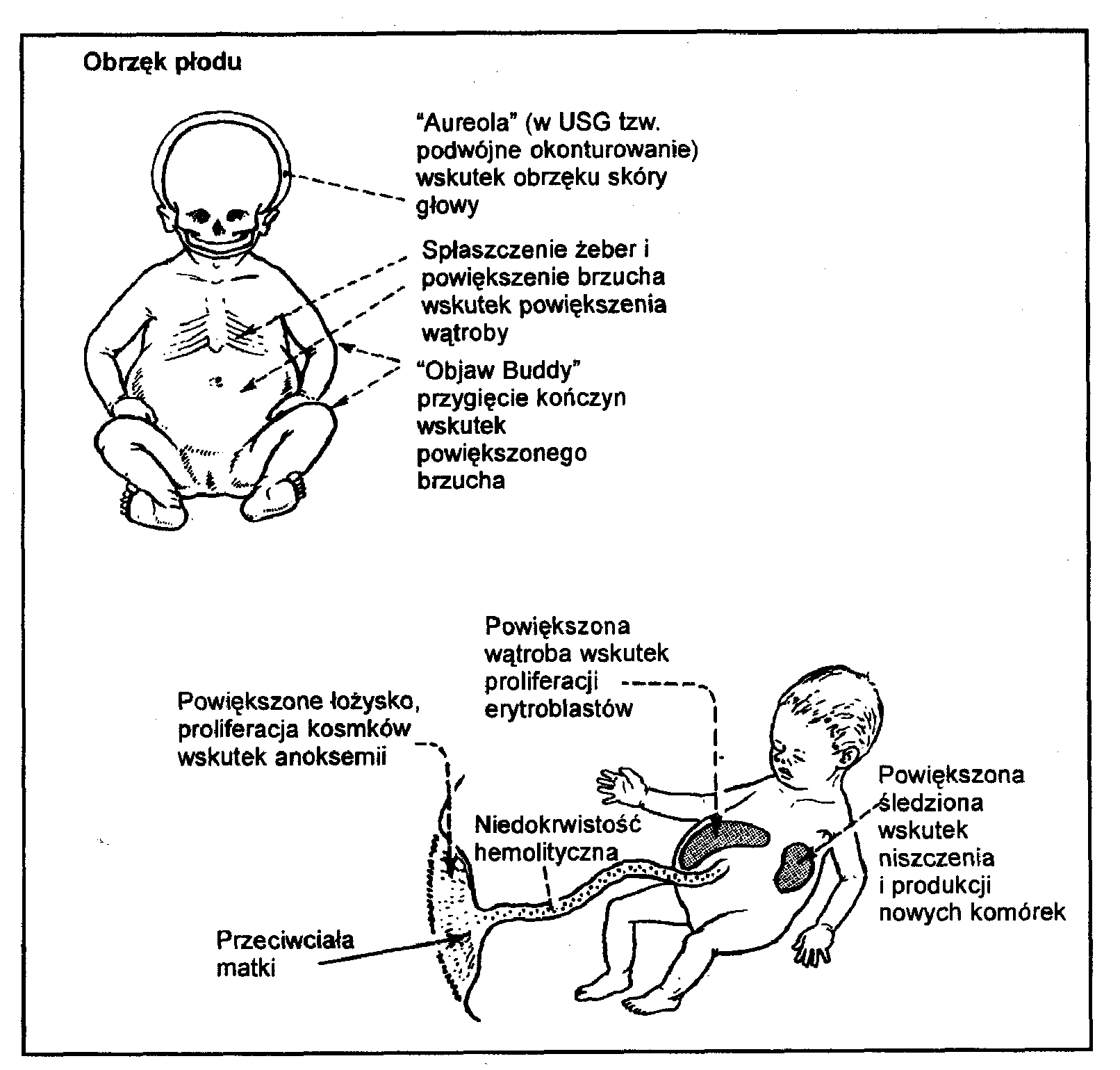  Rycina 1. Skala Lileya używana do oceny stopnia immunizacji 