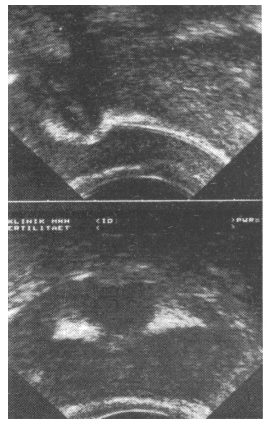  Ryc. 2. Ultrasonografia przezpochwowa. Wewnątrz jamy macicy widoczny cewnik. Obraz w przekroju podłużnym (na górze) i p