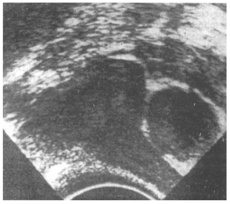  Ryc. 3. Ultrasonografia przezpochwowa, obraz w przekroju poprzecznym. Wewnątrz 