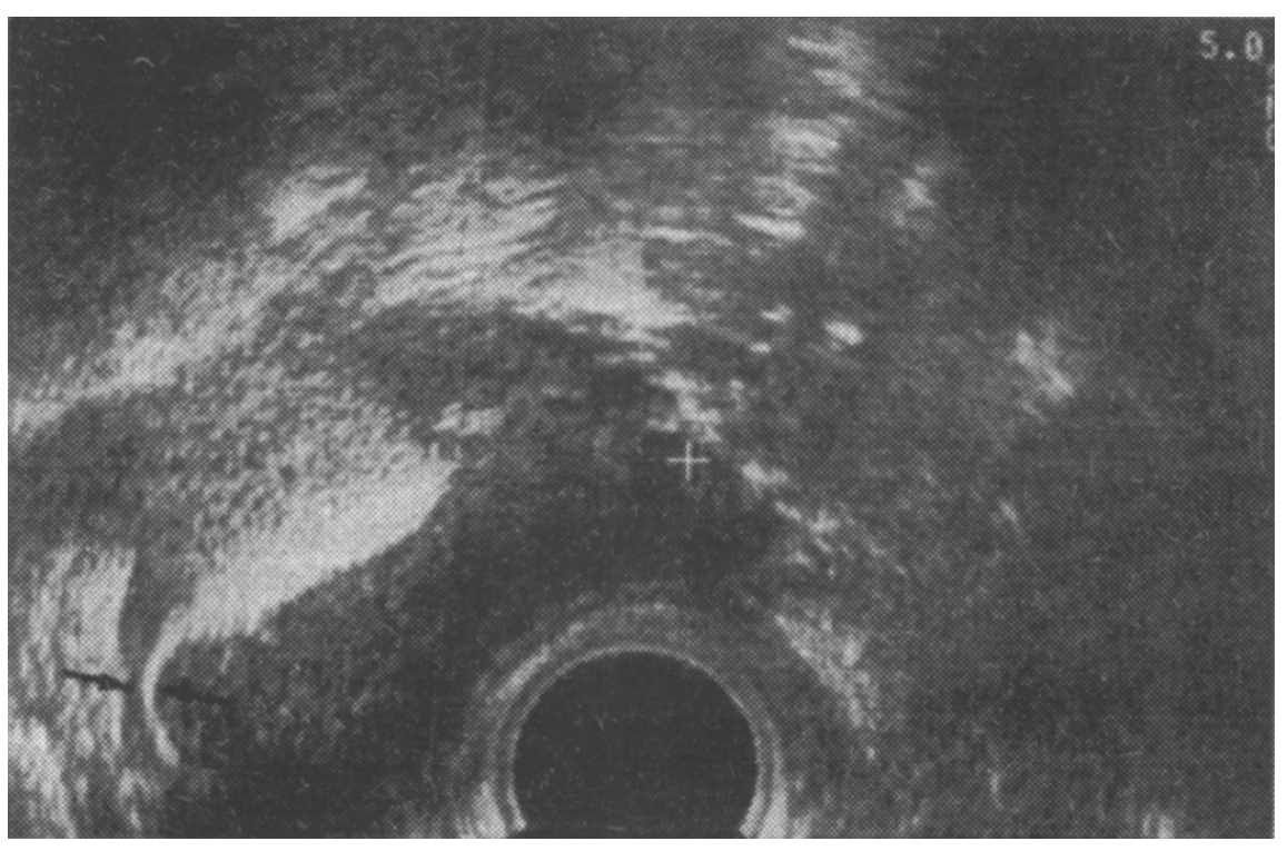  Ryc. 4. Ultrasonografia przezpochwowa (obraz w przekroju poprzecznym): jama macicy bez zmian z drożnym prawym  jajowode