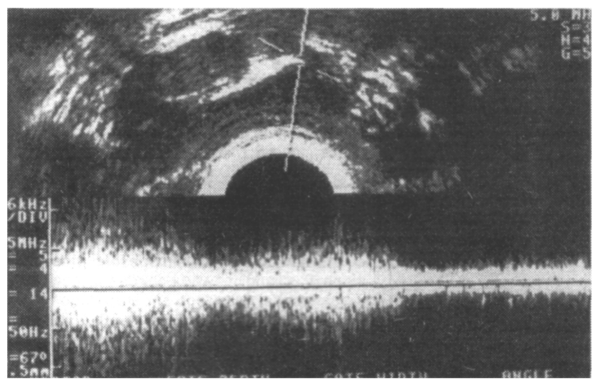  Ryc. 5. Ultrasonografia przezpochwowa wraz z wykorzystaniem metody dopplerowskiej. Sygnał 