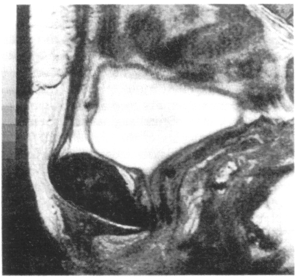  Ryc. 9. Badanie MRI dolnego odcinka układu moczowego w płaszczyźnie strzałkowej w linii środkowej data u pacjentki po u