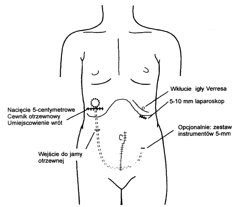  Ryc. 1. Laparoskopowe umieszczenie cewnika wewnątrzotrzewnowego 