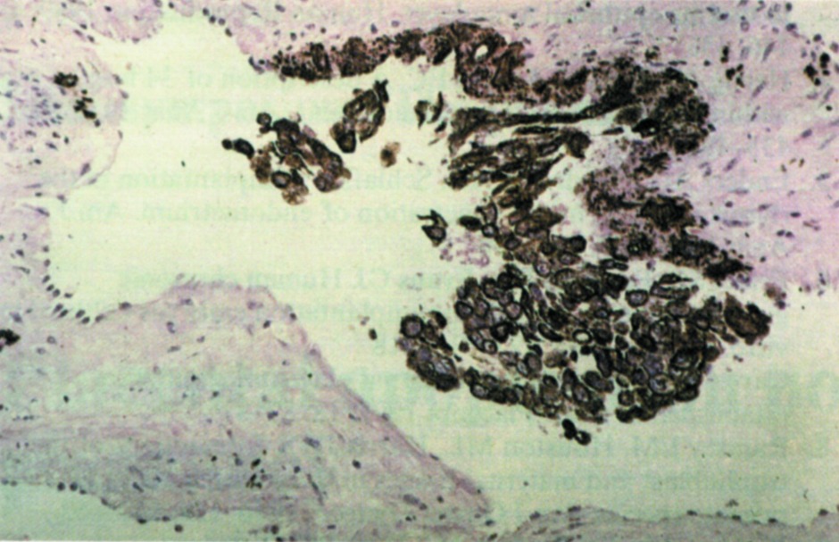  Ryc. 3. Tętnica spiralna w łożysku ludzkim, zawierająca trofoblast wewnątrznaczyniowy częściowo wtopiony w ścianę naczy