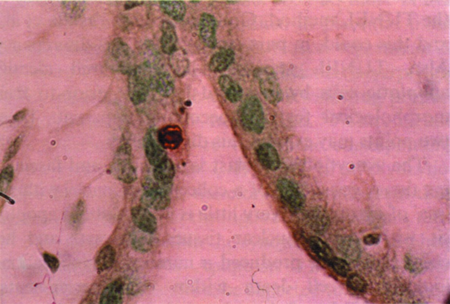 Ryc. 4. Obraz w mikroskopie świetlnym jąder apoptotycznych w guzkach syncytium (syncytiotrofoblast). Łożysko w ciąży do