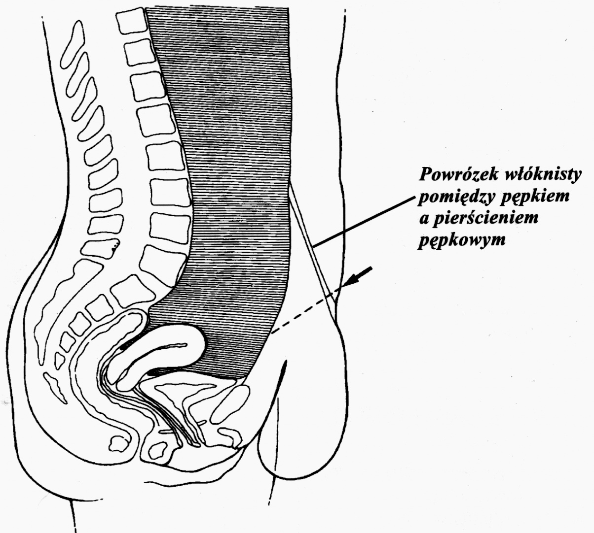  Ryc. 2. Osłabiona powięź u pacjentki w pozycji stojącej, pępek znajduje się na wysokości spojenia łonowego. 