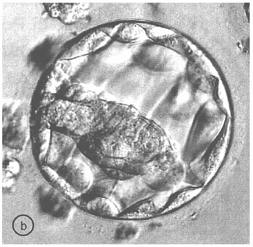 Ryc. 1. W zależności od modyfikacji metody IVF zarodek przenoszony jest do jajowodu lub jamy macicy w różnym stadium: a