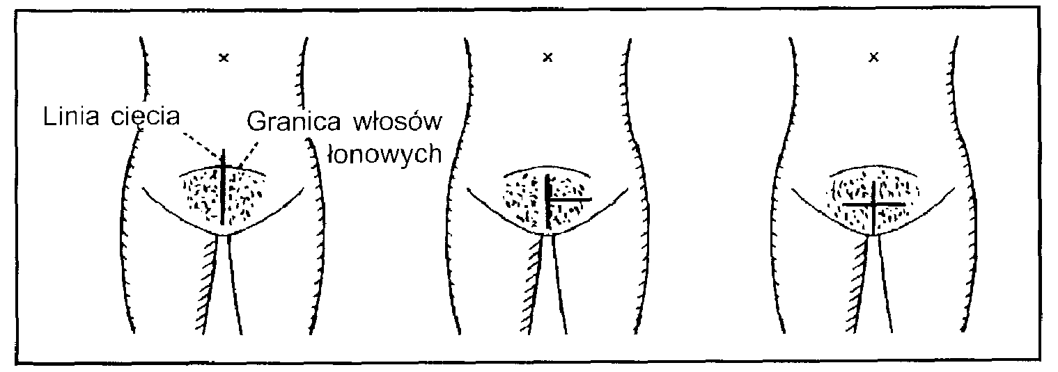  Ryc. 1. Kosmetyczne cięcie cesarskie poprzez małe nacięcie wzgórka łonowego: (a) nacięcie pionowe, (b) poprzeczne nacię