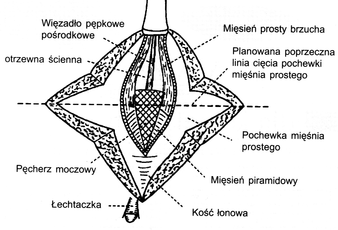  Ryc. 3. Nacięcie w kształcie krzyża pochewki m. prostego oraz warstwy mięśniowej 