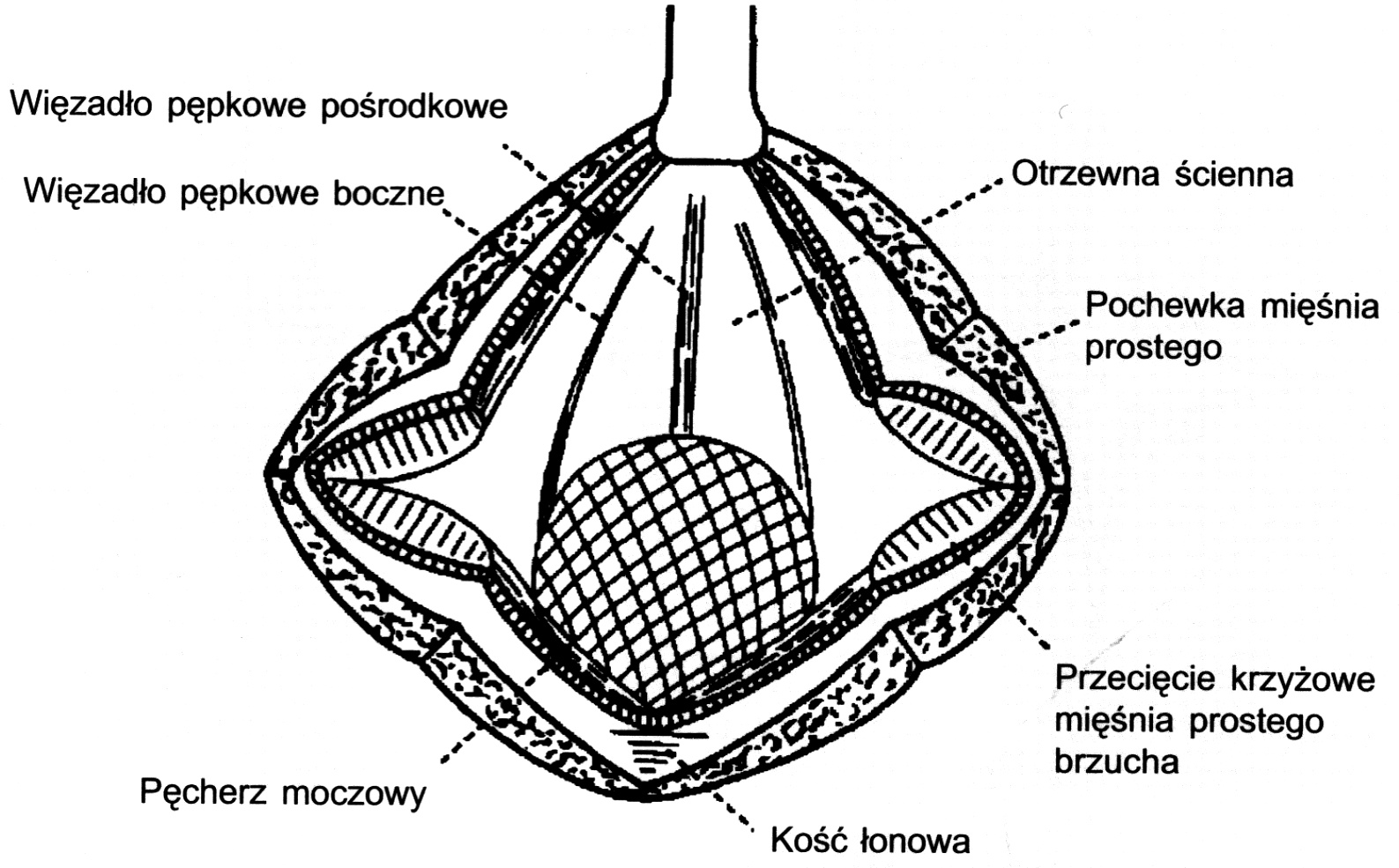  Ryc. 4. Nacięcie w kształcie krzyża pochewki m. prostego oraz warstwy mięśniowej. W rzeczywistości mięsień prosty rozci