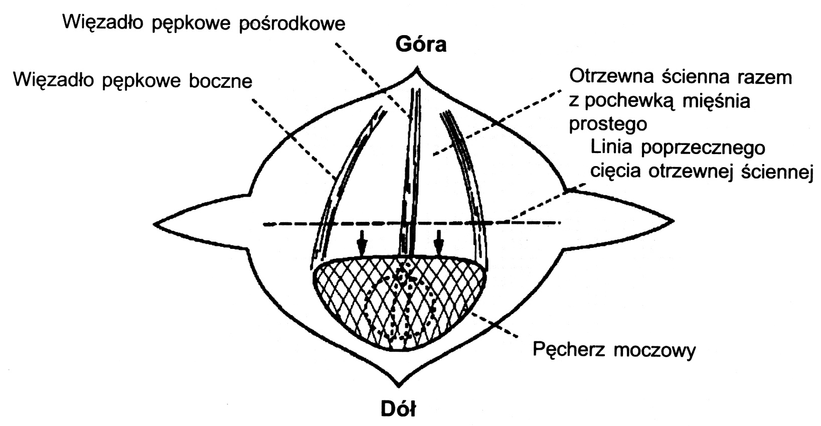  Ryc. 5. Zsunięcie do dołu pęcherza moczowego oraz poprzeczne nacięcie otrzewnej ściennej 