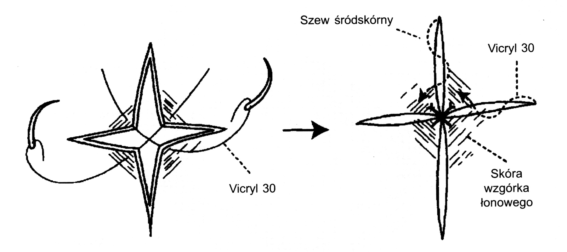  Ryc. 6. Nacięcia w kształcie krzyża. Dwa skrzyżowane szwy proste ściągają rogi i zamykają środek. Dwa śródskórne szwy z