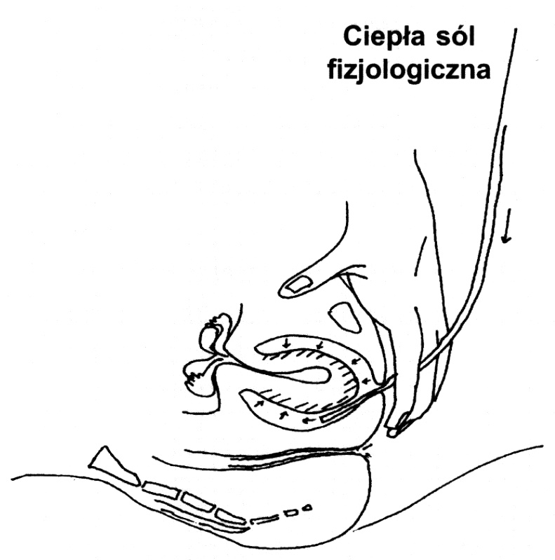  Rycina. Opisana w roku 1945 przez O‘Sullivana metoda odprowadzania wynicowanej macicy polega na wtłaczaniu pod ciśnieni